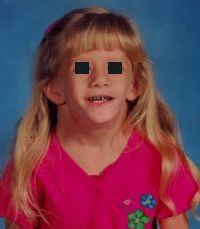 turne syndrome