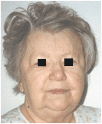 Hypothyroid facies