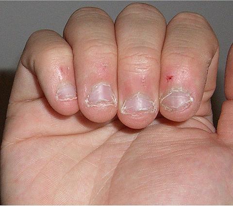 nail abnormalities