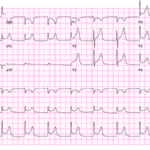 ECG Test