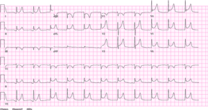 ECG Test