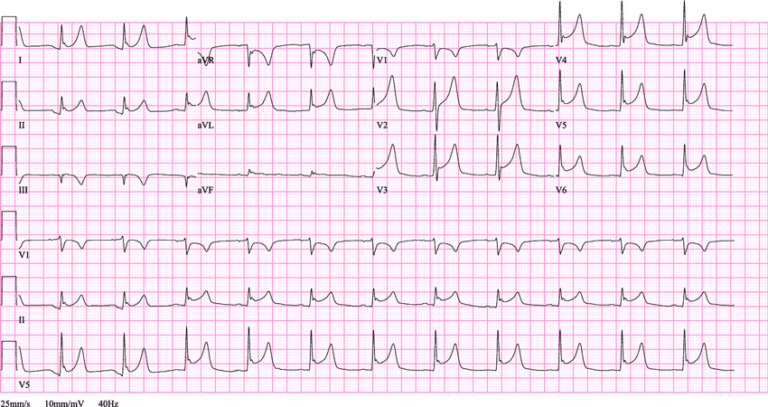 ECG Test