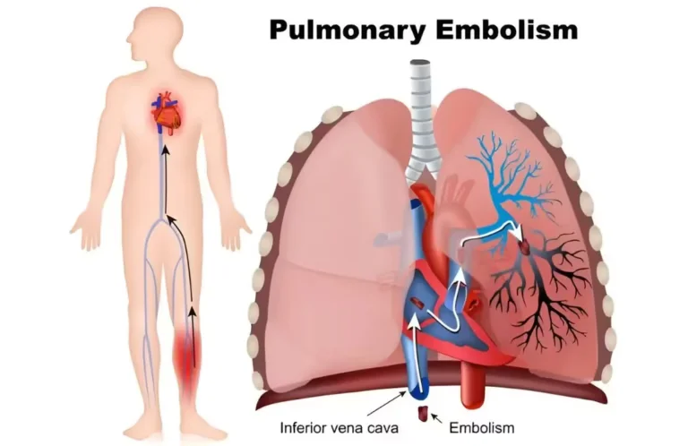 pulmonary embolism
